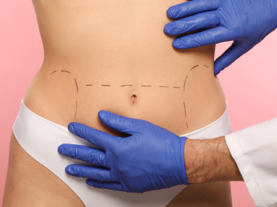 Profissional de estética com luvas realiza avaliação em abdômen de paciente com marcações para cirurgia plástica.